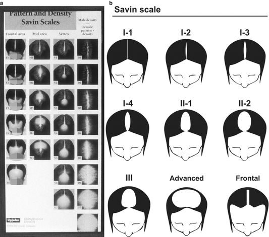 Types of Hair Loss Patterns